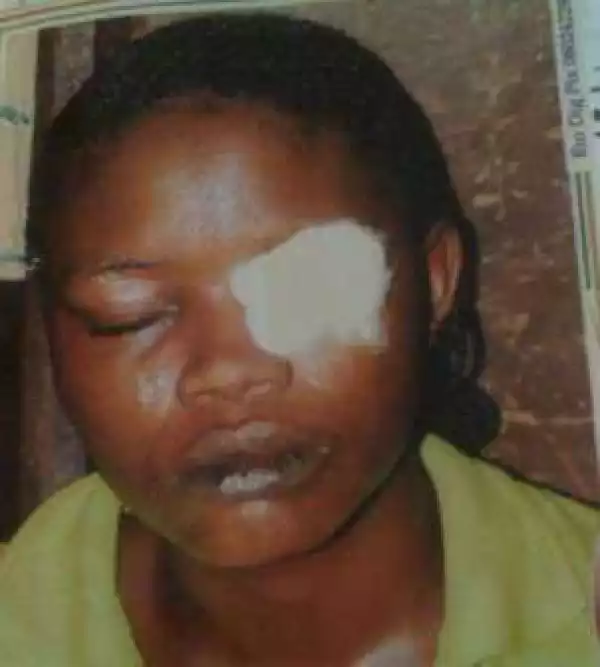Photo: Woman bites off friend’s eyelid after refusing to pay her debt